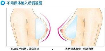 国产隆胸假体介绍视频,创新科技，重塑自信之美